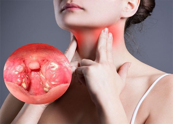Những phương pháp điều trị đau họng bạn cần biết