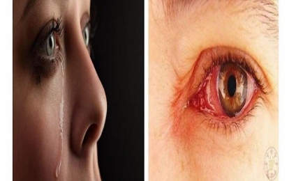 Chảy nước mắt nước mũi: Nguyên nhân và triệu chứng