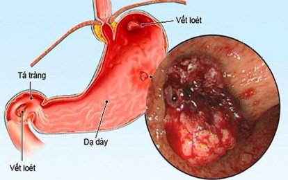 10 triệu chứng của bệnh viêm loét dạ dày bạn nên biết