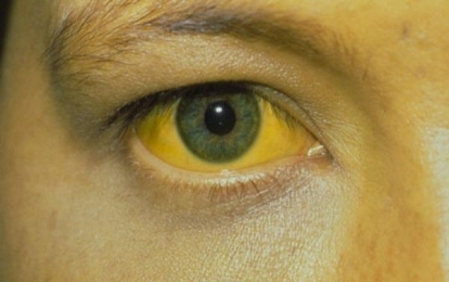 Tìm hiểu về mắt bị vàng và nguyên nhân gây ra tình trạng này
