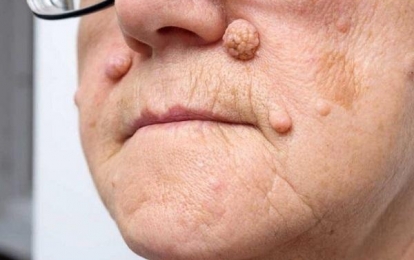 U da lành tính có đáng lo ngại? Những điều bạn cần biết