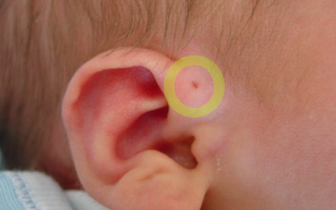 Dị tật rò luân nhĩ, khi nào cần phẫu thuật và biện pháp phòng ngừa nhiễm trùng?