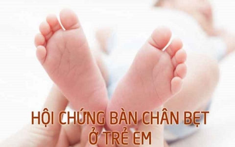 Hội chứng bàn chân bẹt: Nguyên nhân và cách nhận biết hội chứng này ở trẻ em