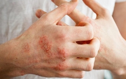 Bí quyết chữa bệnh chàm bằng thảo dược