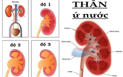 Bí quyết chữa thận ứ nước bằng thảo dược