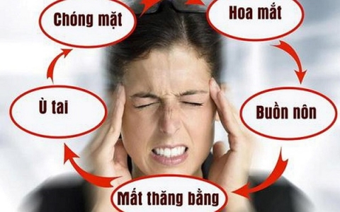 Hội chứng Méniere và thuốc chữa bệnh