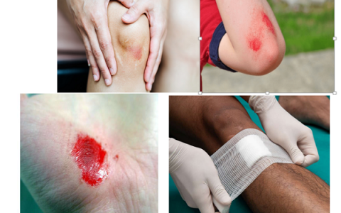 Sử dụng kháng sinh trong điều trị vết thương hở