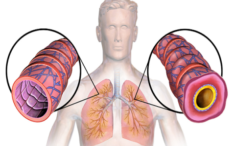 TRIỆU CHỨNG VÀ CÁCH ĐIỀU TRỊ HEN SUYỄN