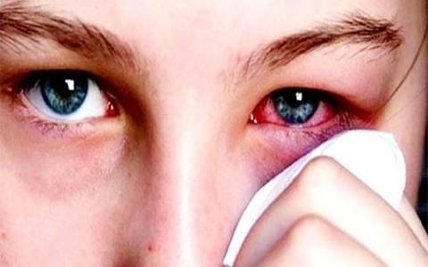 Đau mắt đỏ là bệnh gì? Cách phòng tránh và điều trị