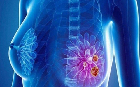 Ung thư vú dấu hiệu nhận biết và phương pháp điều trị