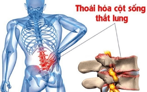 Một số nguyên nhân gây đau lưng thường gặp