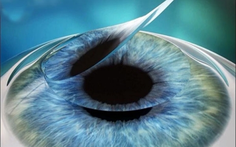 Cần phải chăm sóc mắt sau phẫu thuật LASIK