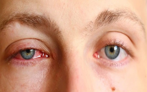 Triệu chứng và phòng chống chứng đau mắt đỏ