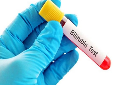 Khi nào bạn cần thực hiện xét nghiệm bilirubin?