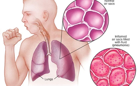 Cách chăm sóc bệnh nhân bị bệnh viêm phổi