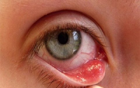 Thông tin cần biết về chứng bệnh đau mắt hột