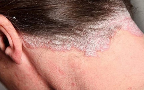Tìm hiểu bệnh vảy nến da đầu, nguyên nhân do đâu gây ra