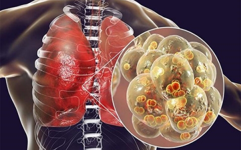 Viêm phổi là gì? Nguyên nhân và phương pháp điều trị viêm phổi