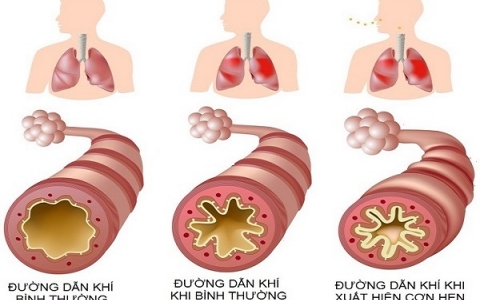 Hen phế quản : Hiểu về nguyên nhân, triệu chứng và điều trị