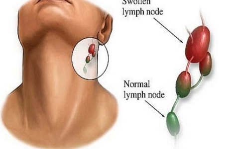 Lao hạch : Nguyên nhân, dấu hiệu và phương pháp chữa trị