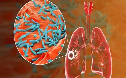 Lao phổi : Nguyên nhân, triệu chứng và các phương pháp điều trị