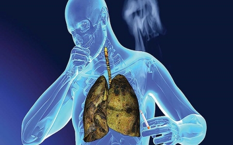 Ung thư phổi : Nguyên nhân, biểu hiện và hướng điều trị