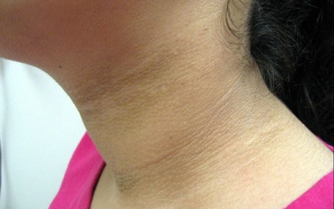 Tác động của bệnh gai đen đối với sức khỏe là như thế nào?