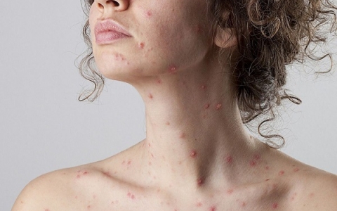 Bệnh Rubella: Nguyên nhân, biểu hiện và cách bảo vệ sức khỏe