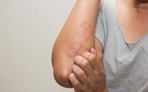 Các dấu hiệu cảnh báo khi gặp tình trạng dị ứng bia
