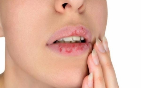 Làm sao để chữa trị bệnh chàm môi một cách hiệu quả nhất?