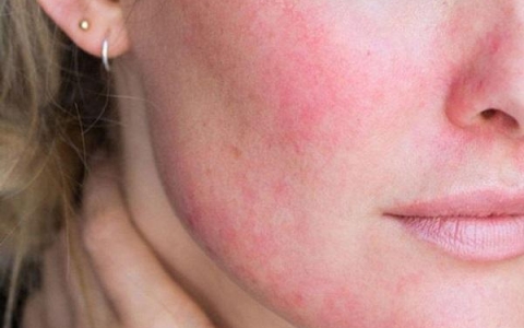 Cách phục hồi da nhiễm corticoid và những lưu ý khi điều trị