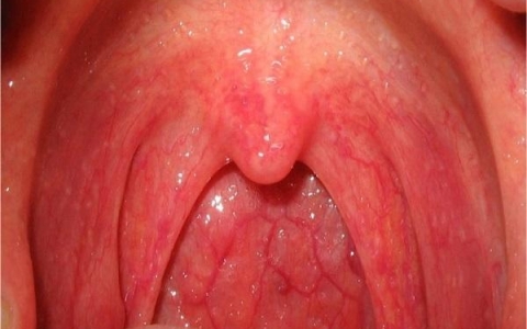 Nấm họng : Nguyên nhân, biểu hiện và cách chữa trị