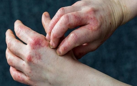 Bệnh Eczema : Nguyên nhân, triệu chứng và biện pháp phòng ngừa