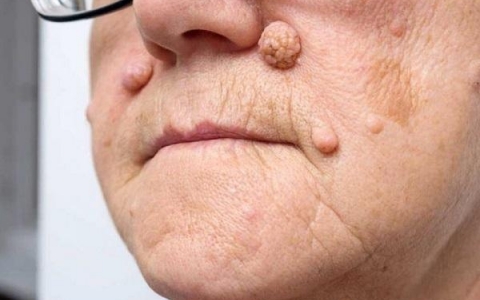 U da lành tính có đáng lo ngại? Những điều bạn cần biết