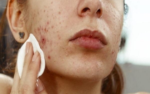 Nước muối sinh lý có thể trị mụn không?