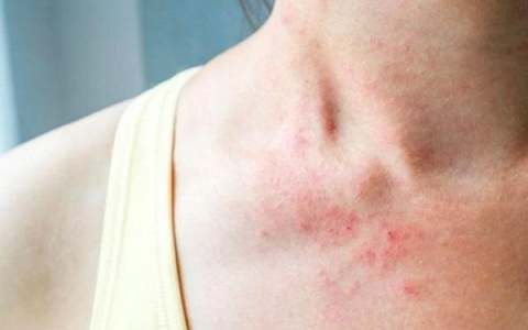 Viêm da cơ địa nên kiêng gì để giảm ngứa và hạn chế tái phát?