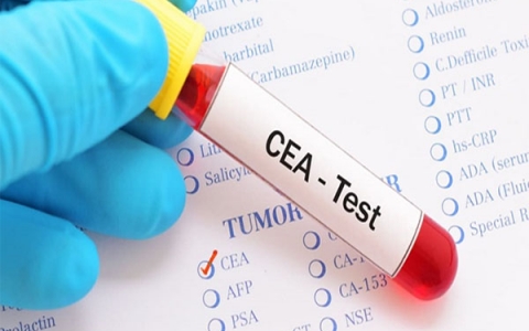 CEA: Xét nghiệm quan trọng trong chẩn đoán và giám sát ung thư