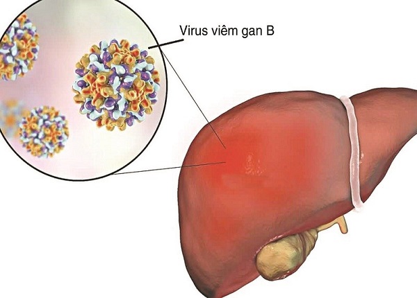 Viêm gan B có thể gây ra các biến chứng nguy hiểm cho người bệnh