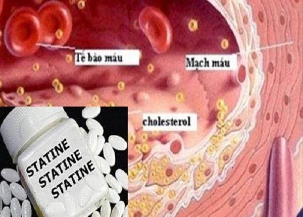 Thuốc Statin điều trị tăng cholesterol và giảm biến cố tim mạch