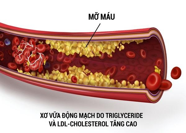 Tăng Triclyceride máu làm tăng tiến triển xơ vữa động mạch