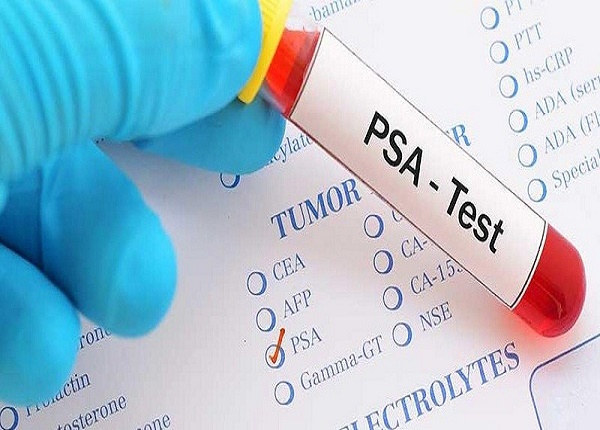 Xét nghiệm PSA giúp chẩn đoán sớm ung thư tuyến tiền liệt ở nam