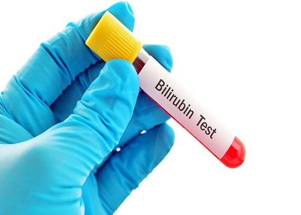 Xét nghiệm bilirubin giúp chẩn đoán bệnh lý gan mật
