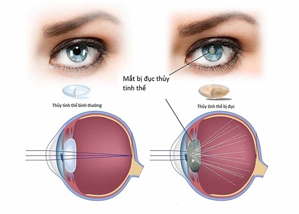 Đục thủy tinh thể là nguyên nhân hàng đầu gây suy giảm thị lực và mù lòa